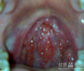 慢性咽炎可以吃咸瓜,传统食疗新体验